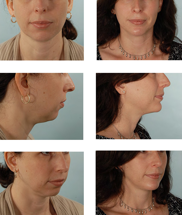 chin reduction surgery female
